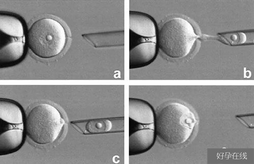 试管婴儿卵泡胞浆置换技术