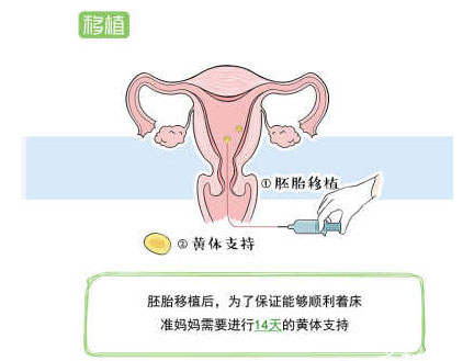在培养液中形成受精卵之后进行胚胎移植