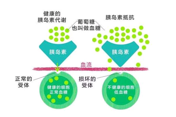 胰岛素抵抗