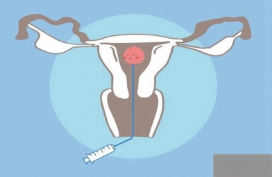 安徽为什么在进行试管婴儿手术还是会出现宫外孕？