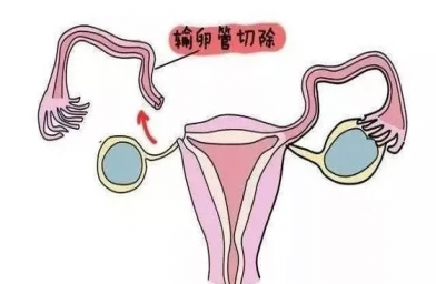 安徽慈铭博鳌国际医院三代试管婴儿，切除双侧输卵管还能做试管婴儿吗？
