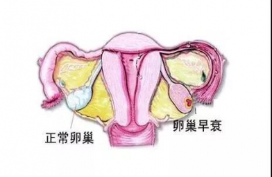 安徽备孕试管婴儿知识_为什么年轻女性也会卵巢早衰？如何防止早衰？